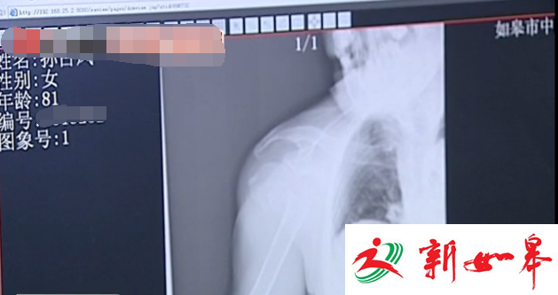 如皋8旬老人骨折住院急需治疗　继子失联无人支付医药费-雉水网