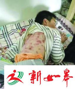 10岁男孩拿钱买零食遭“继父”暴打遍体鳞伤-雉水网