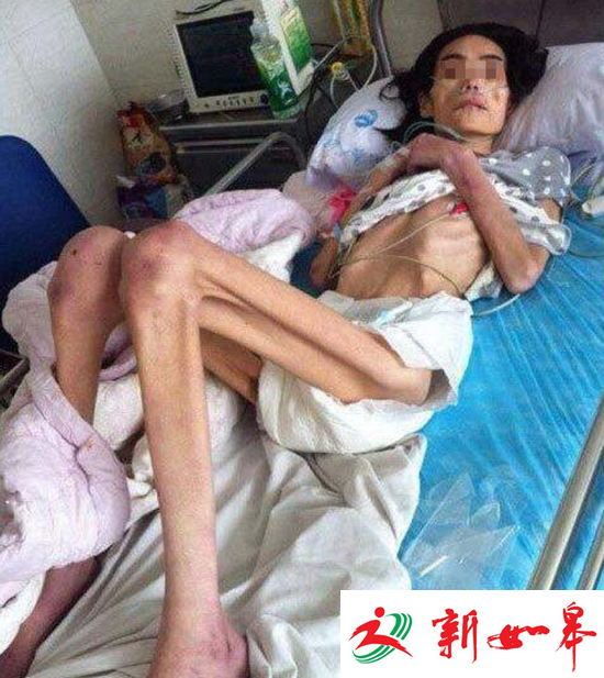 丈夫出轨小三怀孕 原配受婆婆虐待只剩20公斤-雉水网