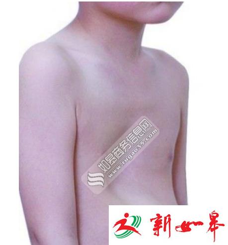 如皋丁堰男孩患漏斗胸疾病　社会各界众筹善款擎起希望-雉水网