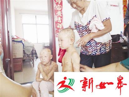 姐妹俩患怪病全身皮肤溃烂 求医11年无果盼救助-雉水网