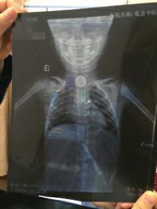 3岁女童误吞硬币卡喉 大人掏硬币弄烂娃食管-雉水网