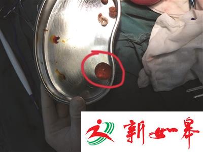 1岁男童误食“水宝宝”失去知觉 家人还以为孩子睡着了-雉水网