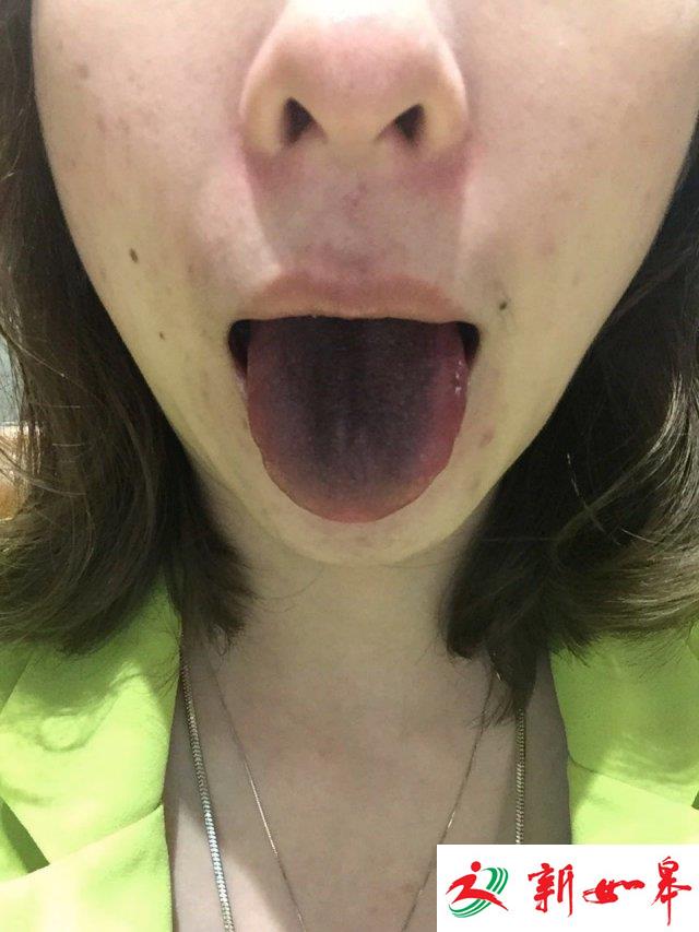 女子吃火锅舌头变黑 商家：铁锅未及时加汤-雉水网