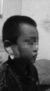 安徽一小学生没写完作业 被老师狠拧耳朵缝5针-雉水网