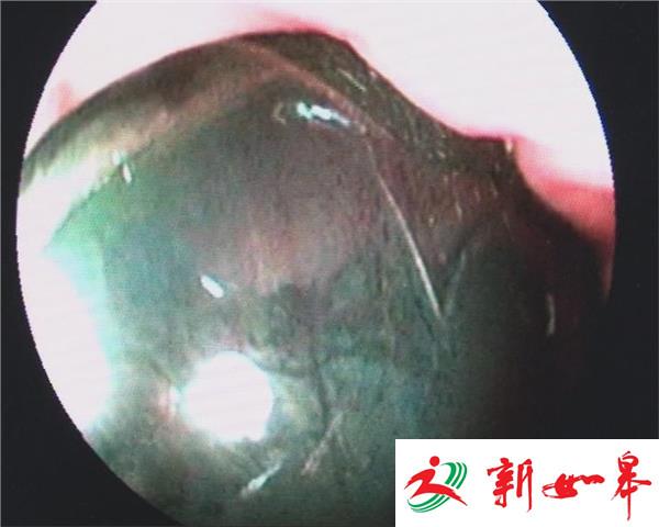 淮安9岁男童误服一元硬币 “宅”在胃里15天取出已发黑-雉水网