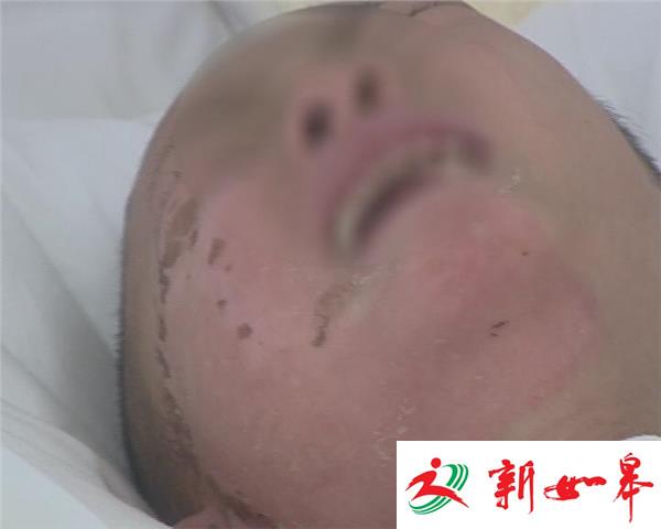 南通一男童掉进热汤桶 全身30%深二度至三度烫伤-雉水网