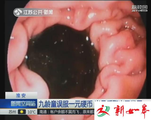 淮安：九龄童误服一元硬币 半月后取出已发黑-雉水网