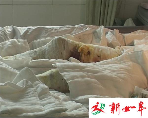 淮安一男子被“高温煤渣”掩埋 严重烫伤面积超九成-雉水网