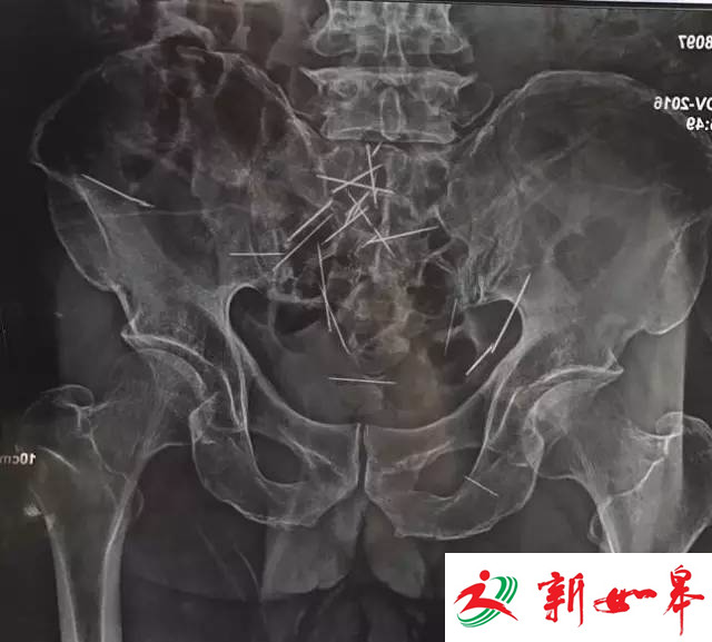 6旬老人腹中现22根绣花针 或已存在几十年-雉水网