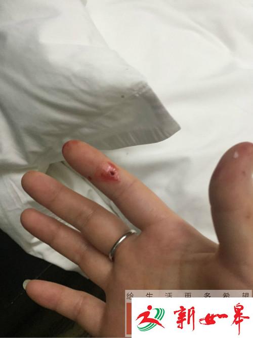 女子入住酒店 半夜醒来床上惊现十几只臭虫-雉水网