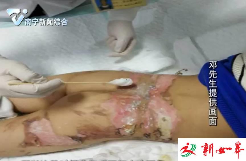 南宁一幼儿园出大事！4岁男童掉进滚烫的汤水桶-雉水网