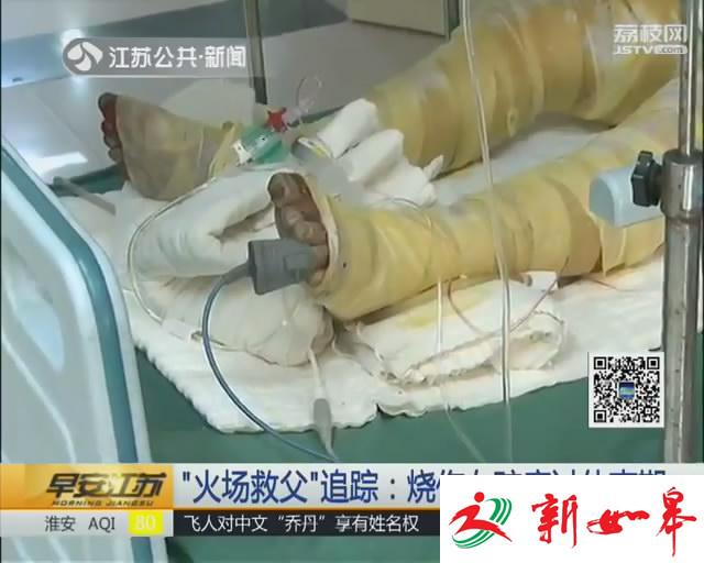 “火场救父”追踪：烧伤女孩度过休克期-雉水网