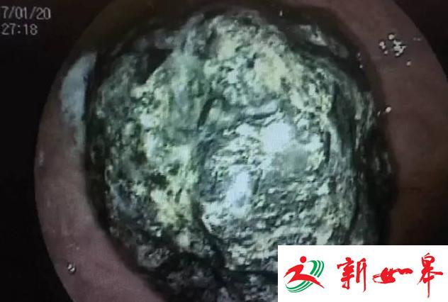 9岁男孩呕吐不止突然变瘦 竟因爱吃糖葫芦-雉水网