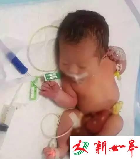 刚出生女婴大年初二被弃医院 消化器官都露在肚子外-雉水网