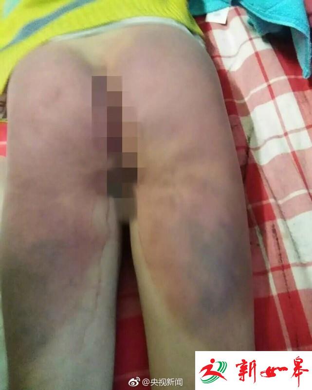 山西一小学教师体罚学生 致其腿部臀部大面积淤血-雉水网