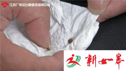 2岁男童不明原因发烧 扒开头发一看脑后寄居着一只蜱虫-雉水网
