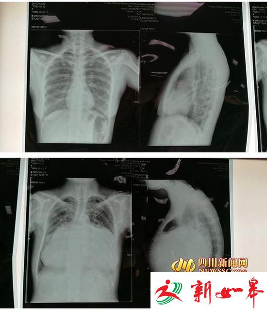 上图为正常人的胸部CT。下图为张女士的胸部CT，可以看到，她的心脏几乎占满左右胸腔。