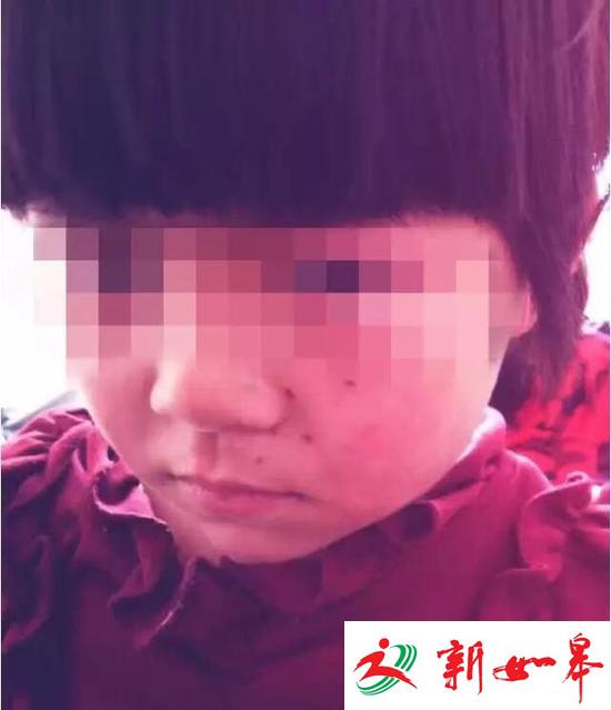 10+9没算好 郑州6岁女童小脸被&ldquo;老师&rdquo;扎6个洞