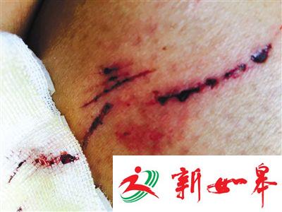 北京清河出现恶犬 咬伤12人多人伤情严重