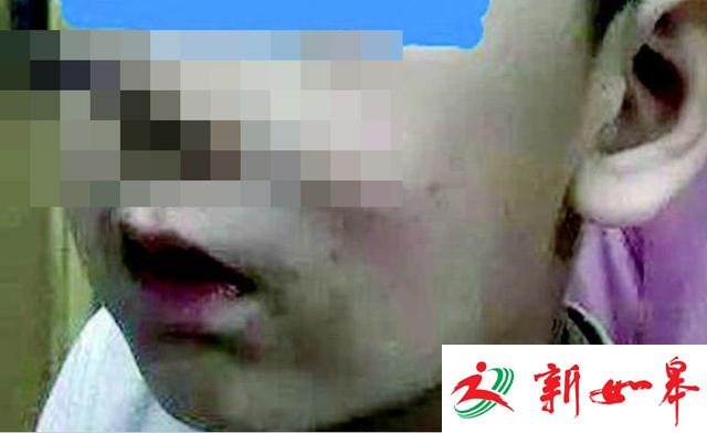 男童被训斥不慎摔倒 长十几厘米铅笔插入鼻腔