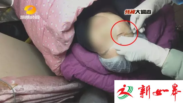 揭非法微整形:用牙签量顾客眼皮 厕所门口做手术