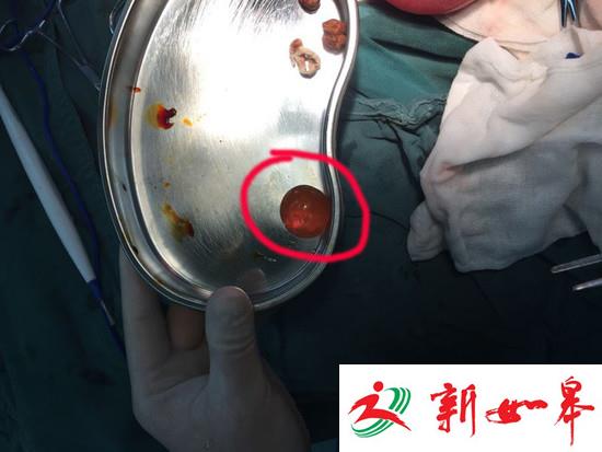 1岁男童误食“水宝宝” 取出时胀如乒乓球大小