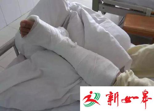 民警右脚脚踝韧带拉伤，打着石膏在医院治疗，需要恢复一段时间。