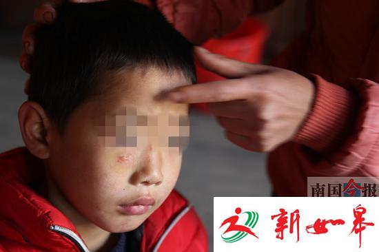 小旺右眼下侧和鼻梁处的疤痕已经结痂，不过家人很担忧。