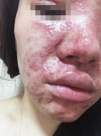 为要二胎断食排毒 七天换来满脸痤疮