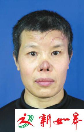 黄春娥老师鼻部美观及面部瘢痕问题