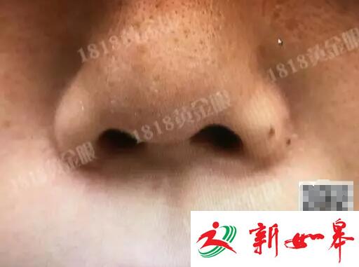 姑娘为整容打掉肚里的孩子 鼻孔被整成成