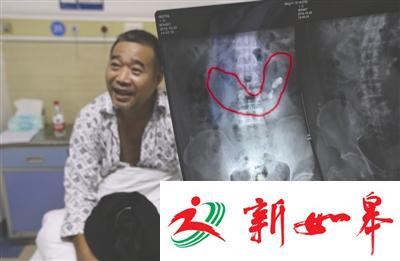 男子双肾相连长成马蹄肾 结石十多年都没碎干净
