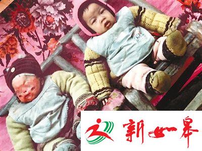 男童脸被烧伤遭遗弃 养父母靠捡废品抚养其长大