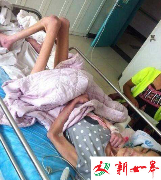 丈夫出轨小三怀孕 原配受婆婆虐待只剩20公斤