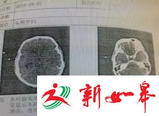 深圳男子被罕见&ldquo;吃脑虫&rdquo;侵入 十几天后病逝