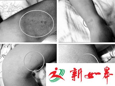 北京3岁男童全身疑遭针扎10处：老师用针扎的