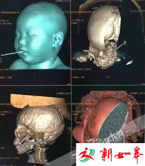家长追着喂饭 重庆2岁男童摔倒筷子插进嘴巴(图)