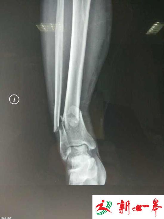 扬州老音乐家被电动车撞断腿 家属悬赏寻逃逸者