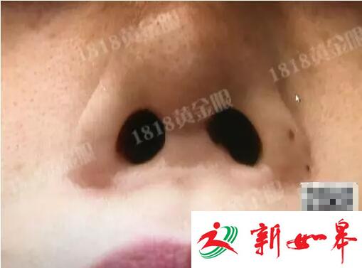 姑娘为整容打掉肚里的孩子 鼻孔被整成成