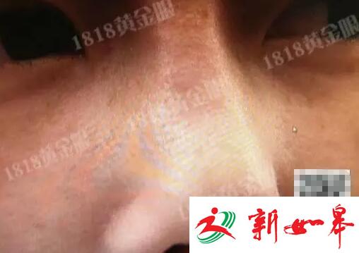 姑娘为整容打掉肚里的孩子 鼻孔被整成成