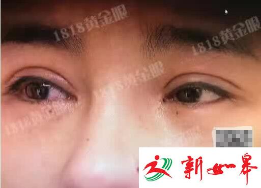 姑娘为整容打掉肚里的孩子 鼻孔被整成成