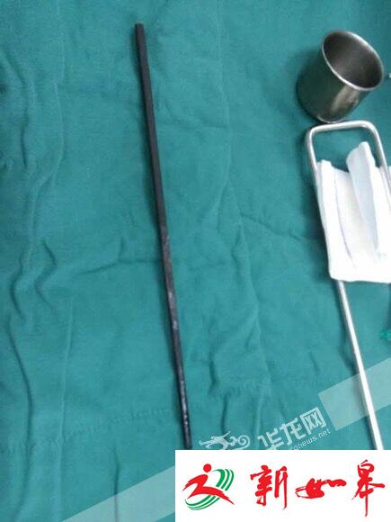 家长追着喂饭 重庆2岁男童摔倒筷子插进嘴巴(图)