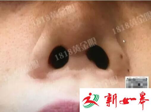 姑娘为整容打掉肚里的孩子 鼻孔被整成成