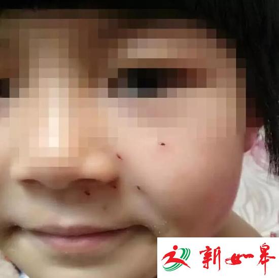 10+9没算好 郑州6岁女童小脸被&ldquo;老师&rdquo;扎6个洞
