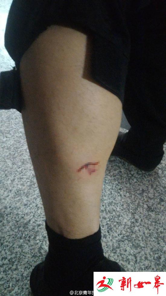 网曝北京多处出现疯狗咬人事件 已致20余人受伤