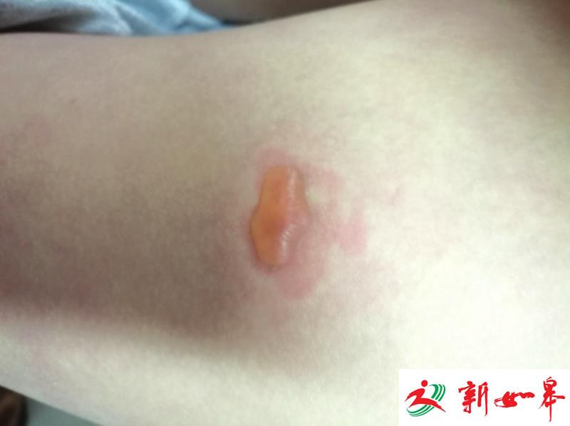 　　被低温烫伤起了水泡