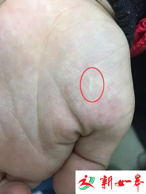 小宝被割开的右手掌（现已快愈合） 孙朝晖主任供图