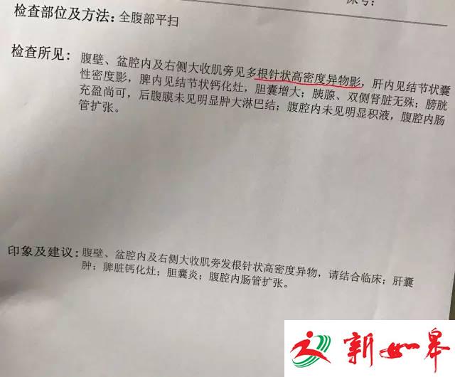 67岁老人不适就医 发现22根绣花针已埋在体内多年